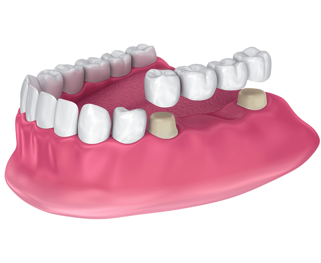 A 3D illustration of an upper jaw shows dental crowns fitted on two teeth with a dental bridge spanning the gap between them, replacing missing teeth. The gums and remaining teeth are also visible.