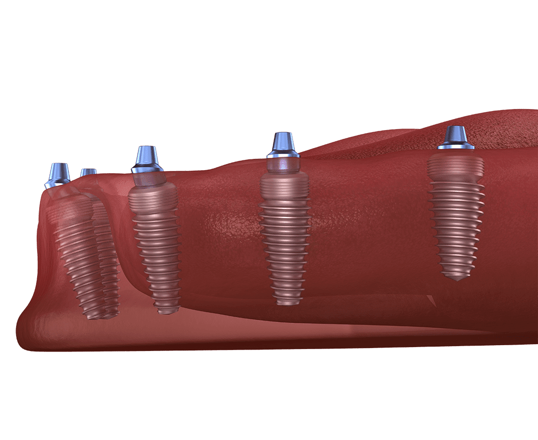 A digital illustration shows five dental implants inserted at different angles into a section of gum and jawbone, demonstrating their placement for dental restoration.