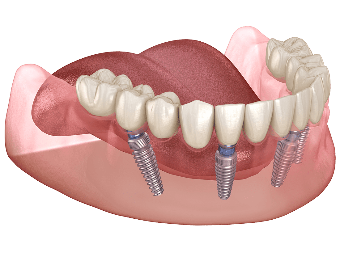 3D illustration of a lower jaw with four dental implants supporting a row of artificial teeth, showing the gum tissue and the positioning of the implants with a visible tongue in the background.