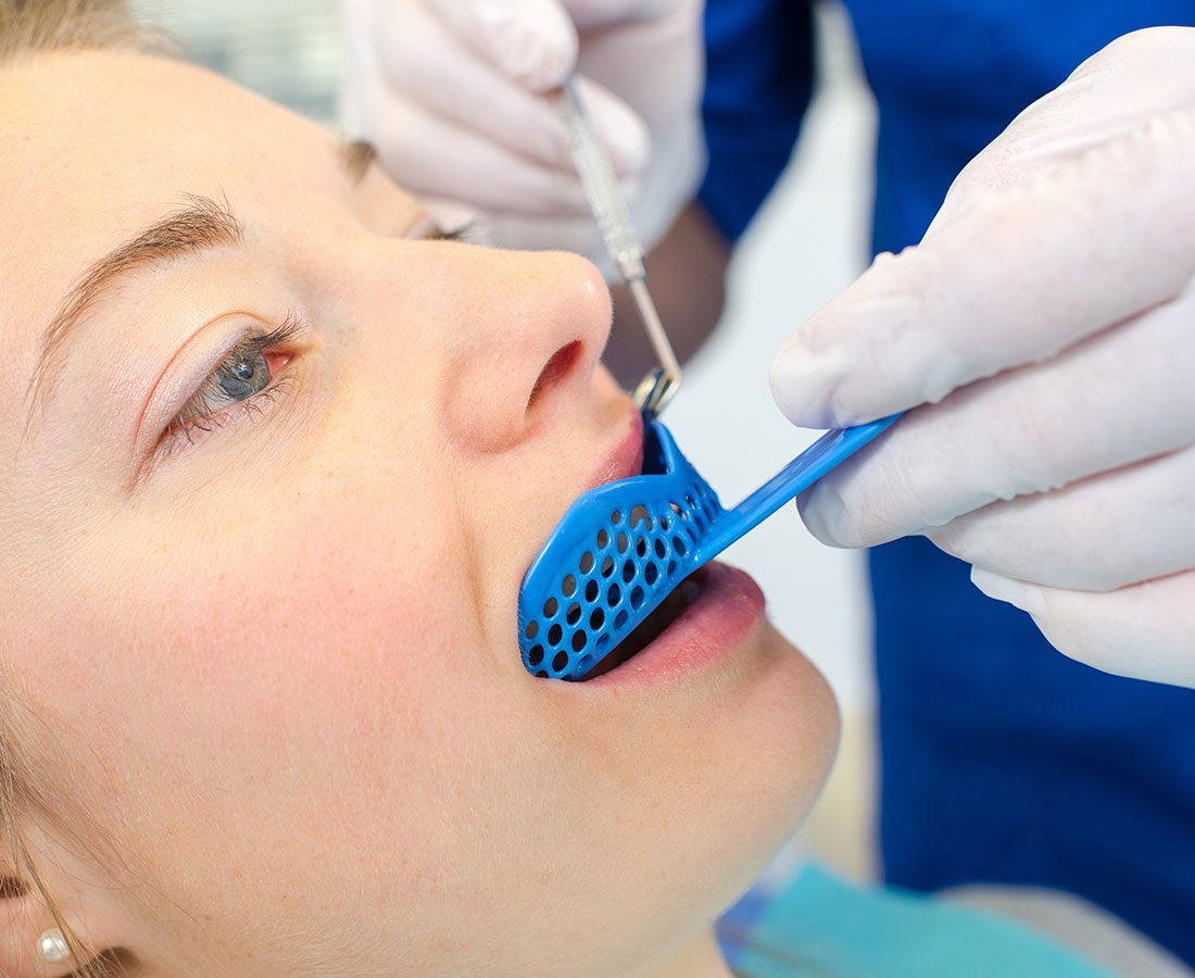 A close-up of a person at a dental appointment, lying back with their mouth open as a gloved dental professional places a blue dental impression tray in their mouth.